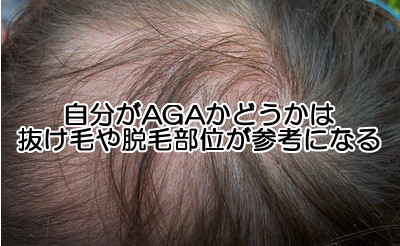 自分がagaかどうか調べるには？判断基準は頭の場所と症状の進み方