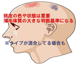 頭皮の状態で貧血・血行不良・炎症タイプを見分ける方法