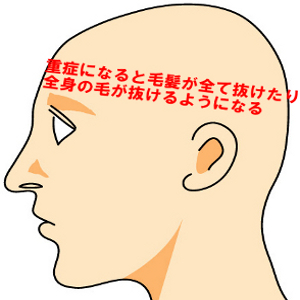 円形脱毛症の症状は軽いものから重いものまで５種類存在する