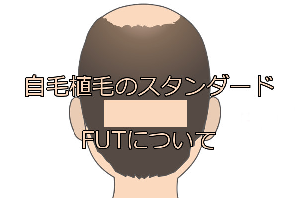 自毛植毛の基本であるFUTの特徴 欠点は解消されつつある