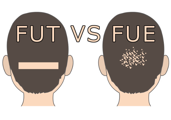 FUTとFUEを注意深く比較すると見えてきた大切なこと