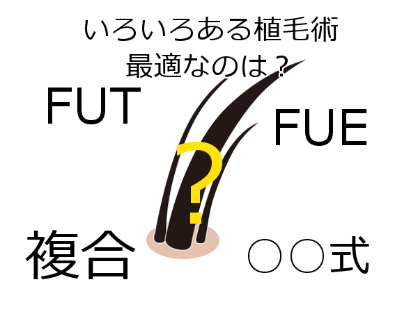 自毛植毛には色々な種類があるが…最適な方法は何か