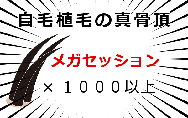 メガセッションの凄さと魅力 植毛は一度に最大何本まで可能？