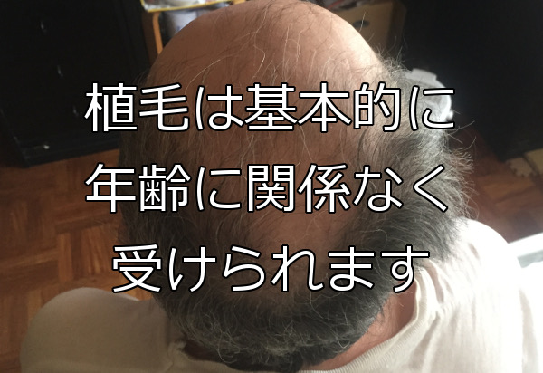 自毛植毛に年齢制限はない 未成年でも老齢でも健康なら可能