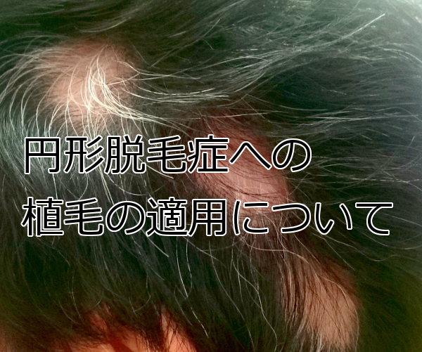 植毛は円形脱毛症にも有効なのか 検討はより慎重に
