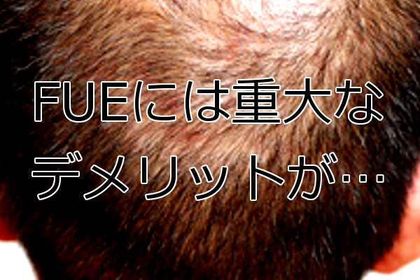 FUEの隠れたデメリット 後頭部がスカスカになる恐れなど