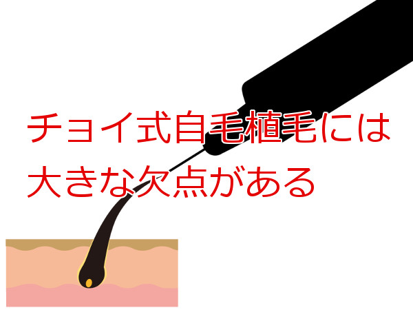 植毛術の一つであるチョイ式について デメリットが大きい