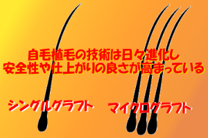 自毛植毛の３つの施術方法について｜現在は遊離移植法が主流